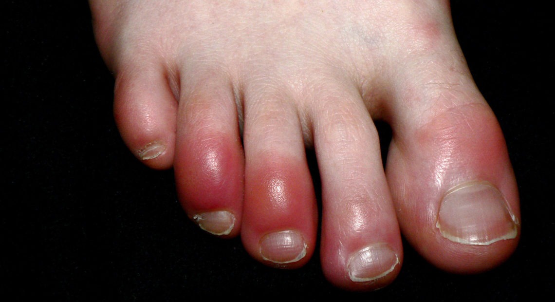 Chilblains (pictured) are itchy, red, pink or purple inflammations of the skin's small blood vessels that can develop in body parts such as toes and fingers from exposure to colder temperatures or wet conditions. A similar-looking inflammation of the toes is an emerging symptom of COVID-19 and is being referred to as "COVID toes."